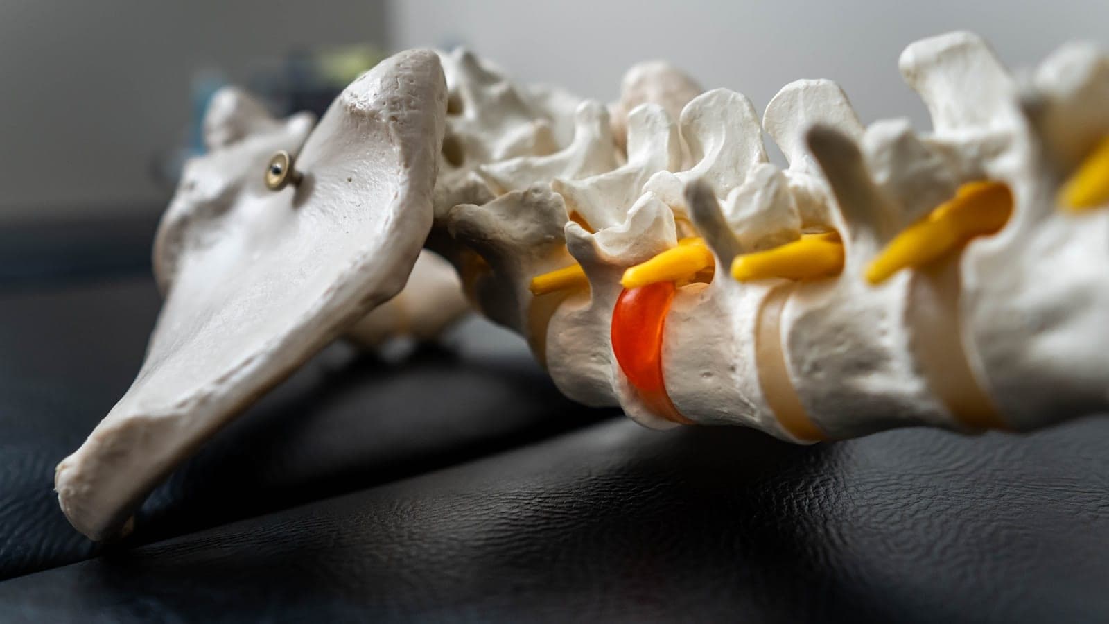An anatomical model of the lumbar spine showing a compressed disc